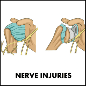 axillary nerve palsy