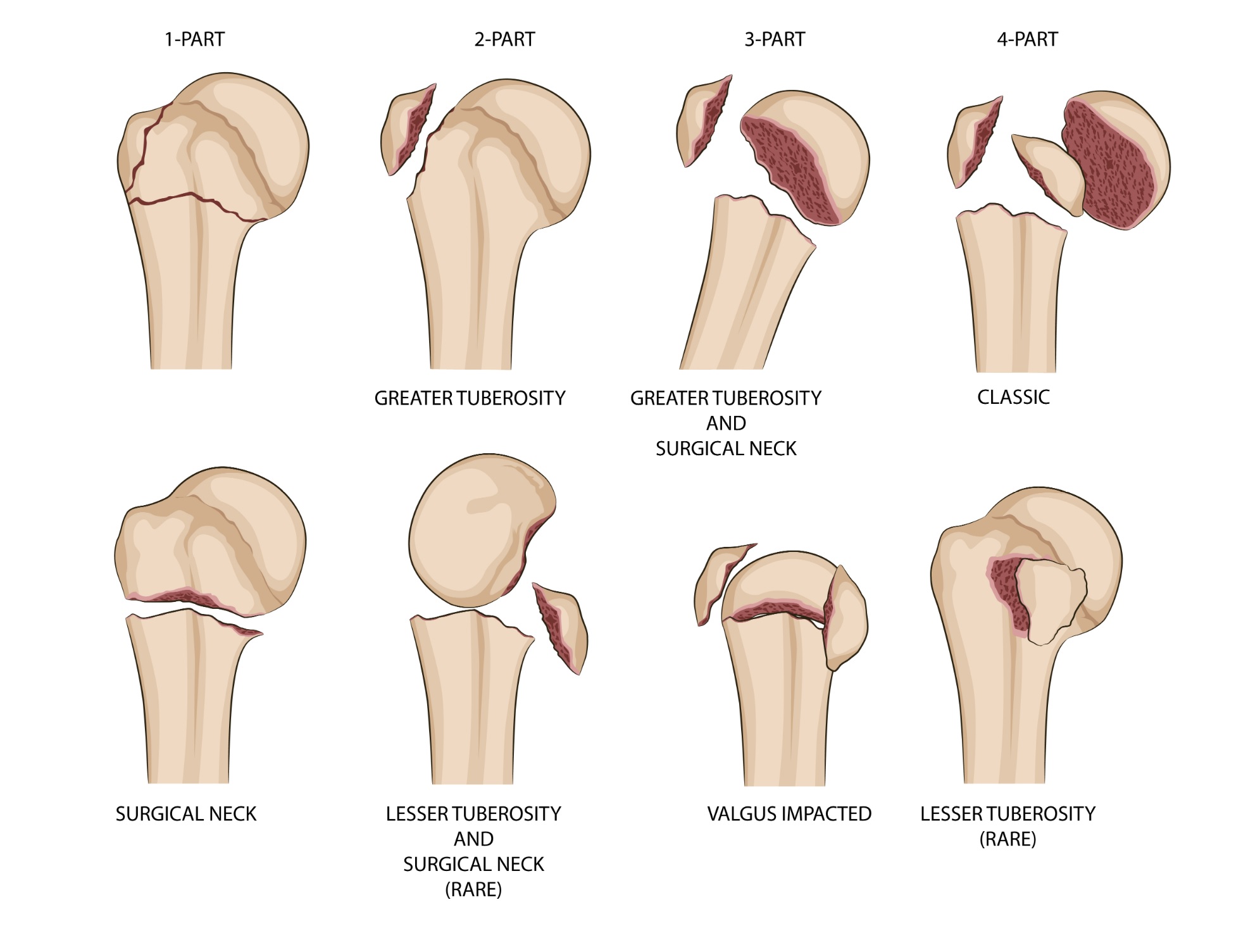 Auckland Shoulder Clinic - Shoulder Physiotherapy - humeral head fractures animations