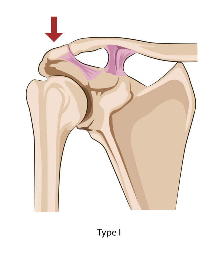 Injured your AC Joint? Auckland Shoulder Clinic