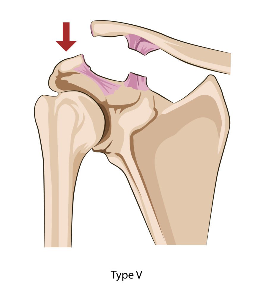 Injured your AC Joint? Auckland Shoulder Clinic