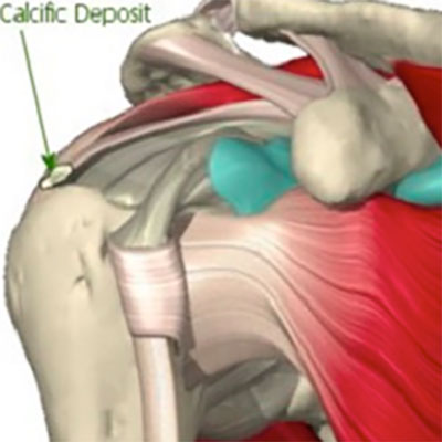 Auckland Shoulder Clinic - Shoulder Physiotherapy - Calcific Tendinitis